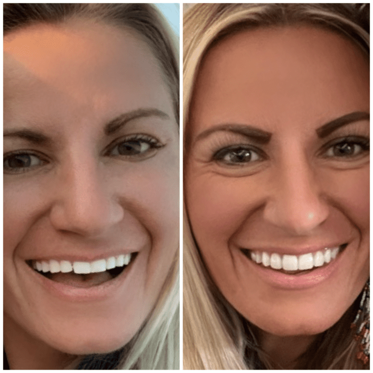 5 Ways I Saved Thousands on Porcelain Veneers: Your Affordable Smile Makeover Guide